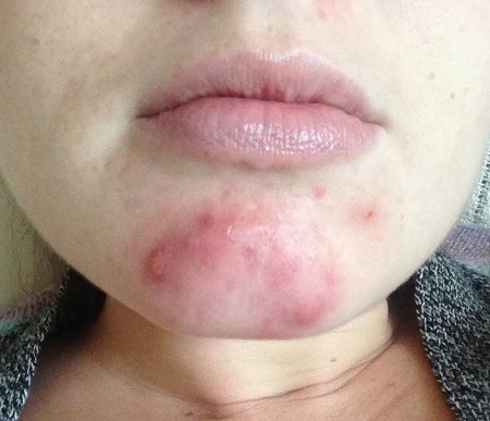 độn cằm bị viêm