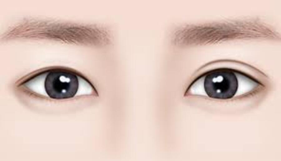 mí mắt không đều phải làm sao