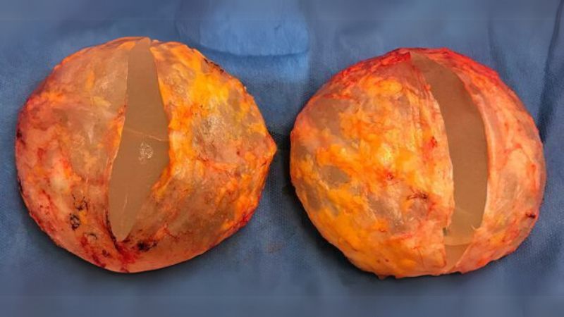 Dấu hiệu nâng ngực bị bao xơ là gì?