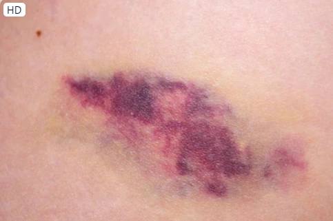 Nâng ngực bị bầm có sao không?