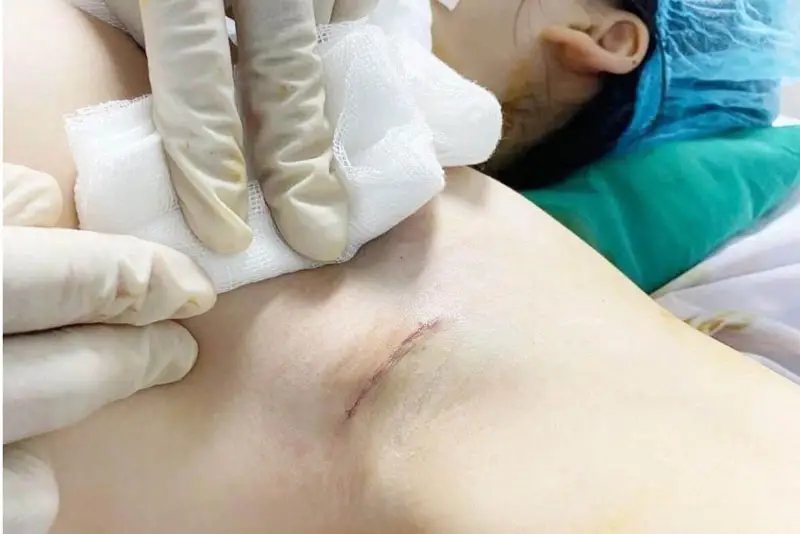 Nâng ngực đường nách có tốt không?