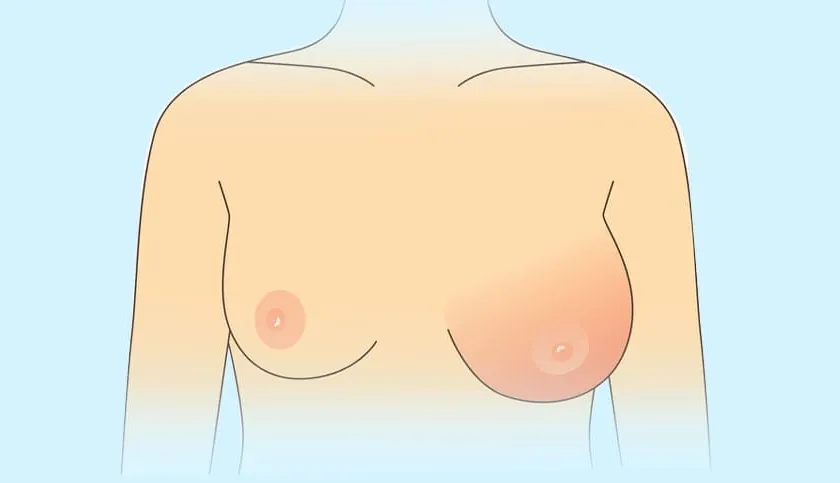 nâng ngực không đều có phải do sưng không